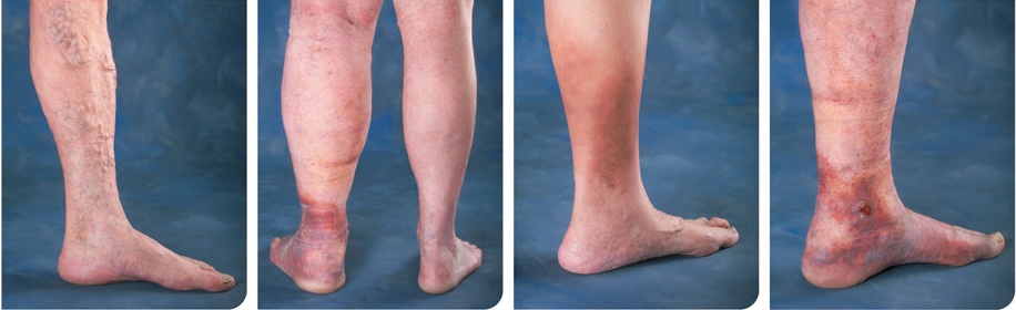 Noge, različne stopnje otekanja