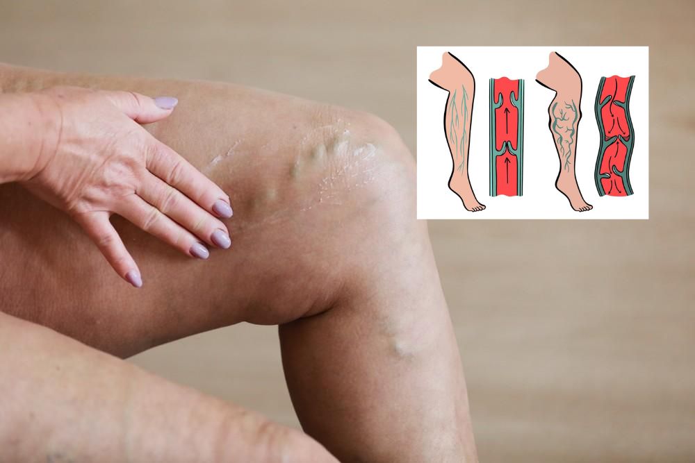 Noge, otekanje, žile