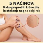 5 načinov kako preprečiti krčne žile in otekanje nog