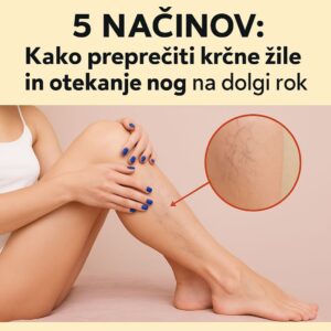 5 načinov kako preprečiti krčne žile in otekanje nog